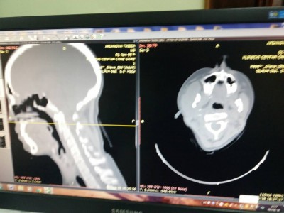 cervical spine-5 febr-1.jpg